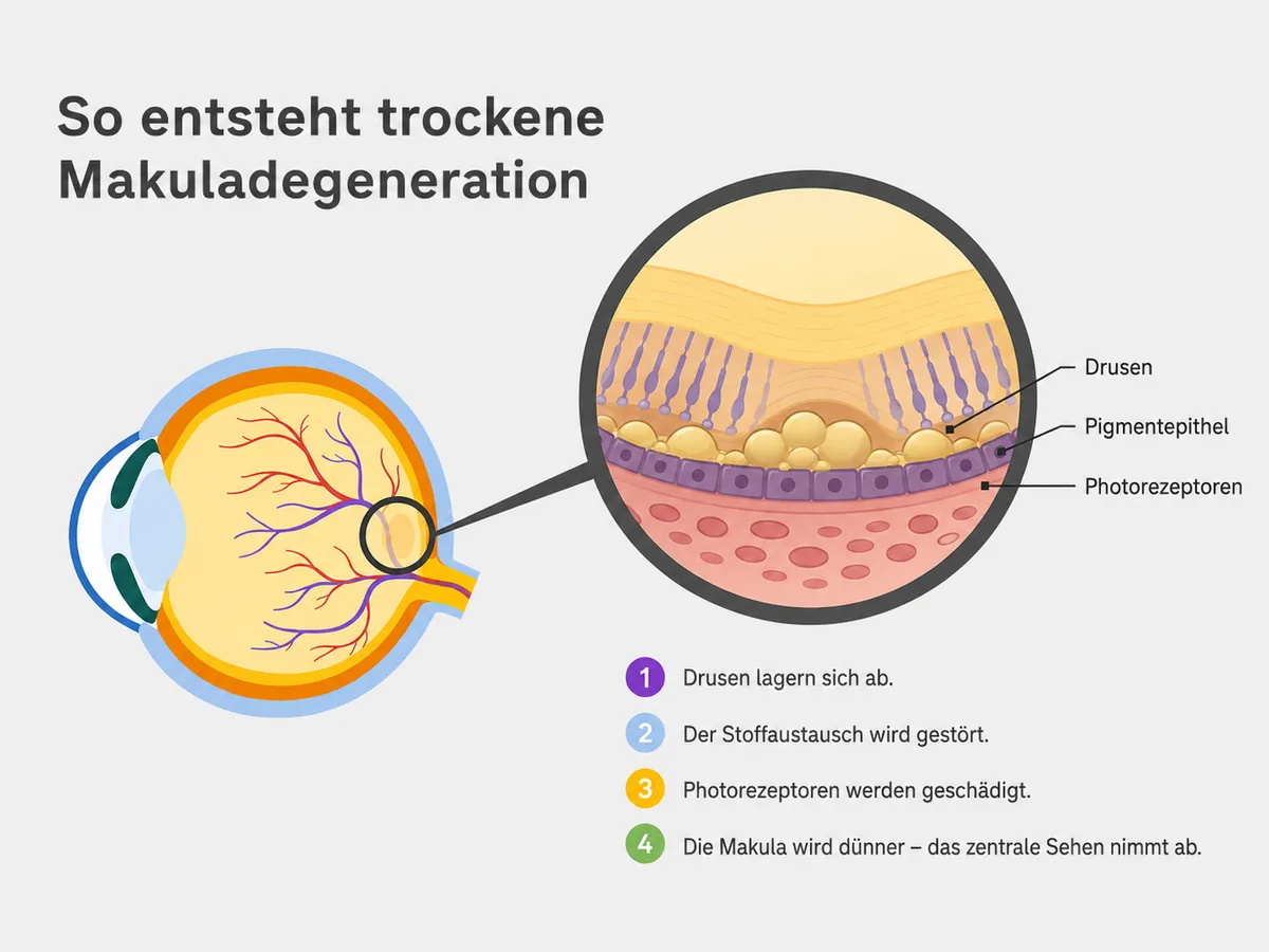 Illustration der Entstehung einer trockenen Makuladegeneration in vier Schritten: Drusen lagern sich ab, der Stoffaustausch wird gestört, Photorezeptoren werden geschädigt, die Makula wird dünner und das zentrale Sehen nimmt ab.